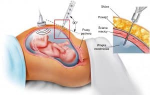amniopunkcja w ciąży